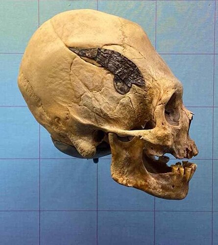 The Oklahoma-based museum has an early Peruvian elongated skull, which underwent skull surgery, as part of its collection. (Museum of Osteology)