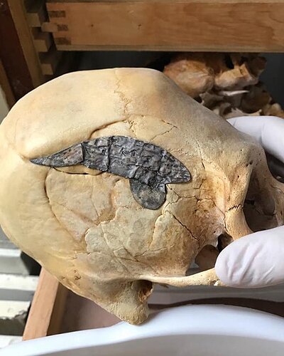 Peruvian elongated skull which underwent skull surgery and had metal surgically implanted to bind the bones after being wounded in battle about 2,000 years ago. (Museum of Osteology)